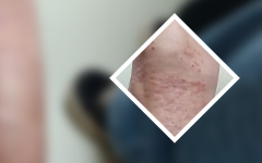 老人预防和防护腿部牛皮癣